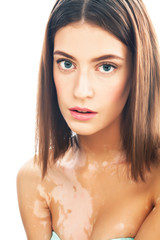 Fototapeta premium beautiful young brunette woman with vitiligo disease close up isolated on white