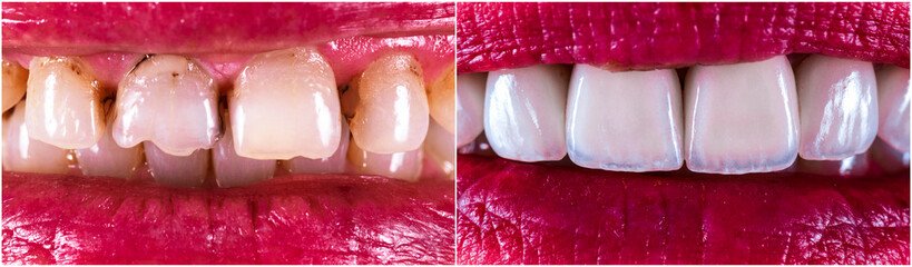 14 unit zirkon based press ceramic crowns , before and after the treatment