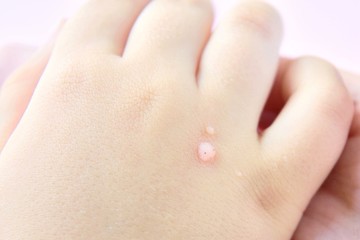 The doctor holds a small hand of a child affected with warts with selective focus on blurred pink background. Papillomavirus in a child's hand and fingers. Pediatric dermatology. Skin diseases