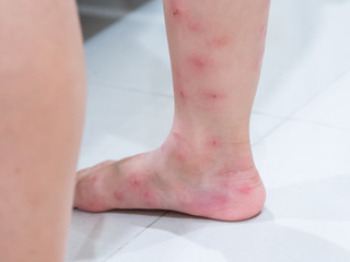 Red blister on a girl's legs after bite by ant (Solenopsis geminata ,tropical fire ant ).