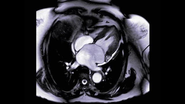 MRI heart or Cardiac MRI ( magnetic resonance imaging ) of heart in axial view showing heart working for detecting heart disease.