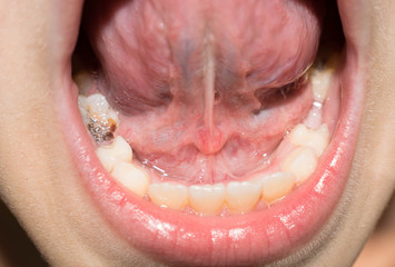 Baby teeth fall out break blacken infected with caries for medicine