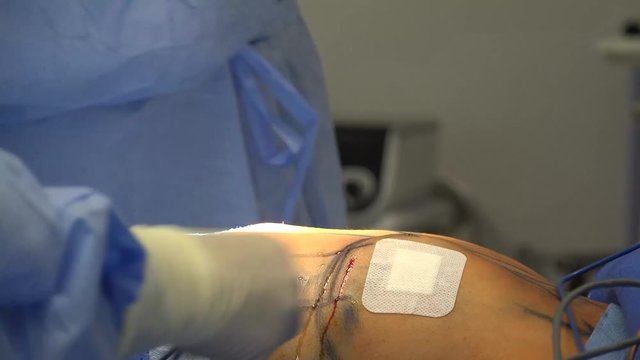 Breast augmentation are plastic surgery terms for the breast-implant and the fat-graft mammoplasty approaches used to increase the size and alter the texture of the breasts of a woman.