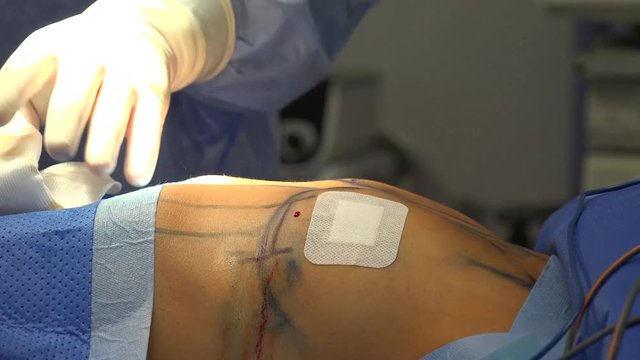 Breast augmentation are plastic surgery terms for the breast-implant and the fat-graft mammoplasty approaches used to increase the size and alter the texture of the breasts of a woman.