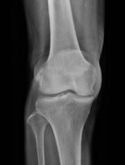 film x-ray knee of osteoarthritis knee patient