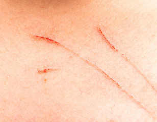 scratches on the skin of a child