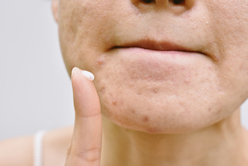 Acne and face skin problem, Woman applying acne cream medication, Topical pimple gel drug treatment.