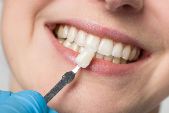 dentist using shade guide at woman's mouth to check veneer of teeth for bleaching