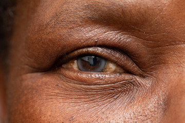 A macro view on the eye of an African grandfather. A cloudy cataract is seen in detail....
