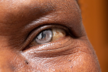 A close-up view on the iris of an old-aged African male with a cataract. Bloodshot eyes with...
