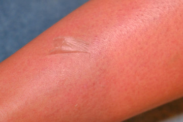 Skin comes off with the women's legs after sunburn Problems of long exposure to the sun. Burnt skin of a woman after a vacation on the beach.