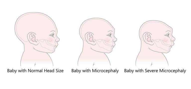 Comparative anatomical image of the head and skull of a newborn child with a normal cranium and with microcephaly and severe microcephaly. Virus of Zika. Isolated on white background