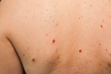 Many birthmarks on the girl's back. Medical health photo. Woman's oily skin with problems acne.