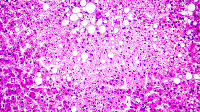 Histopathology of liver steatosis, or fatty liver. Light micrograph, photo under microscope