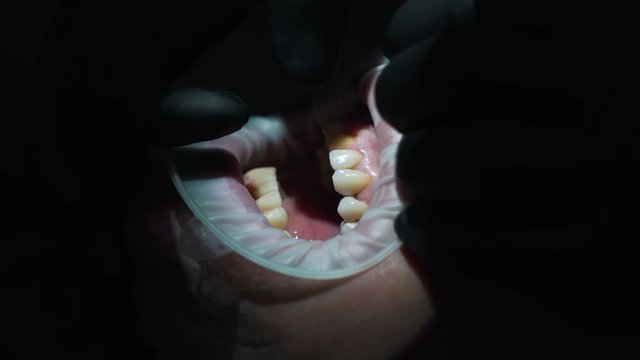 the installation of veneers closeup