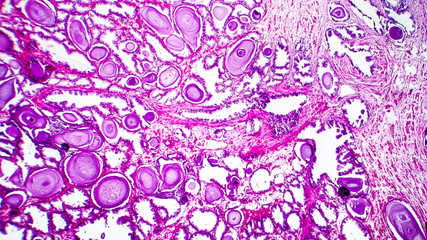 Histopathology of prostate gland hyperplasia, light micrograph, photo under microscope