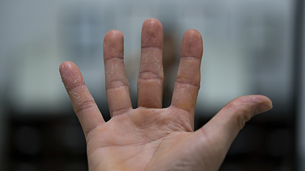 Allergic hand such as dishwashing liquid, detergent
