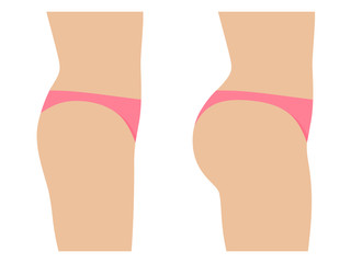 Female ass before and after plastic surgery