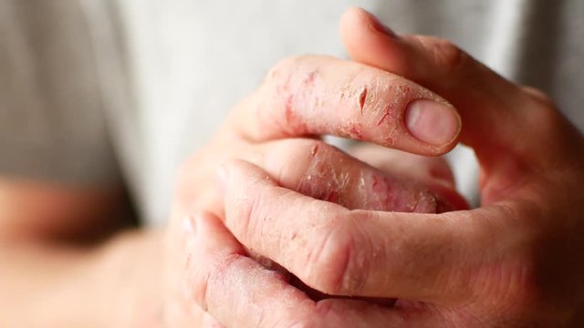 Fingers of a man with psoriasis and eczema. A close-up of the skin peeling