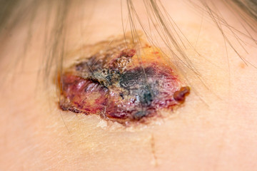 Obraz premium Physical injury wound skin on child forehead. A fresh scar on the forehead. Head injury