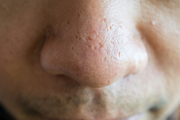 Close up shot of acne scars on man nose. Scars are formed when a breakout penetrates the skin...