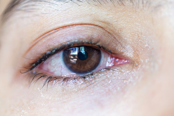 Fototapeta premium Closeup of irritated red eye of a patient with human conjunctivitis or infected red bloodshot eye