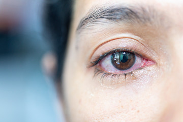 Closeup  of irritated red eye of a patient with human conjunctivitis or infected red bloodshot eye