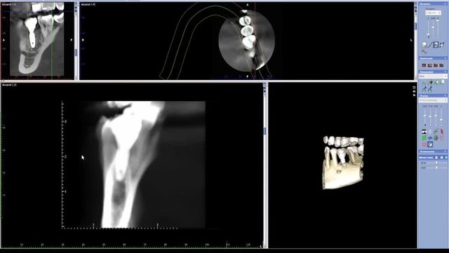 real life MRI scan of chewing side tooth implant for stomatology dentist research new quality medical science dental stock footage screen