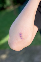 Wound on the hand of a child.