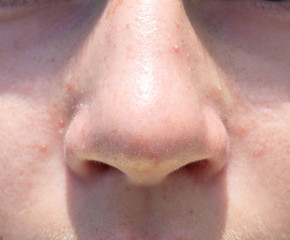 Fototapeta premium Nose teen girl closeup front view acne