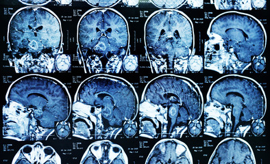 MRI (magnetic resonance image) scan of a patient with a tumor in the brain stem. Neurosurgery,...