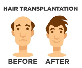 Hair transplantation before and after effect bald man