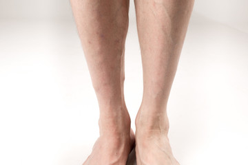 naked legs of a man with varicose veins on a white background