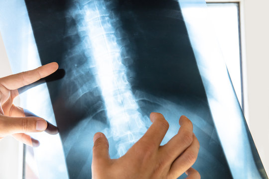 doctor examines x-ray picture of human spine