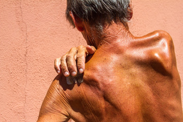 man scratching himself due to eczema on his skin