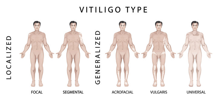 Types of  Vitiligo