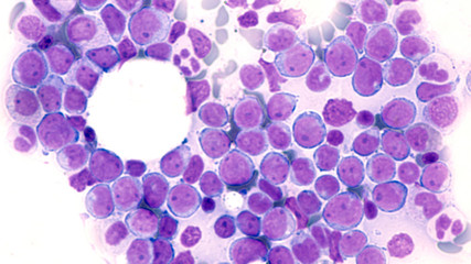 Leukemia Awareness: Photomicrograph of bone marrow aspirate showing myeloblasts of acute myeloid leukemia (AML), a cancer of white blood cells.