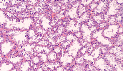 Breast biopsy histology from a pregnant woman showing lactating adenoma, a benign lesion of glands...