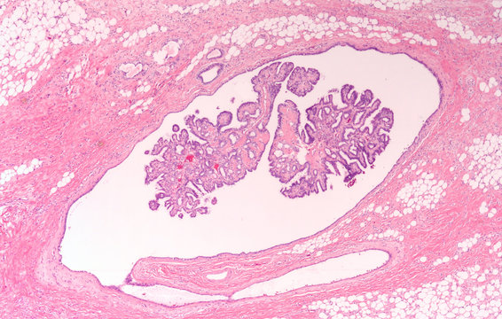 Breast Biopsy: Microscopic image (photomicrograph) of an intraductal papilloma, a benign tumor of the mammary lactiferous ducts (milk ducts).  It is typically treated by surgical excision.  