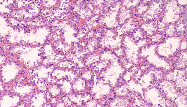 Breast biopsy histology from a pregnant woman showing lactating adenoma, a benign lesion of glands showing secretory changes (milk production).  