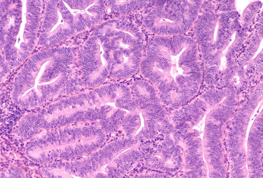 Microscopic image (photomicrograph) of complex endometrial hyperplasia with atypia, from a dilation and curettage specimen (D&C) of a woman with dysfunctional uterine (vaginal) bleeding.  