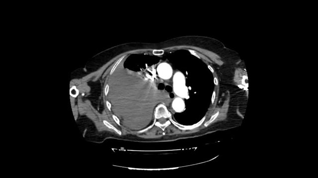 Magnetic Resonance Imaging, Delayed chest wall hematoma caused by progressive displacement of rib fractures, Broken rib scan