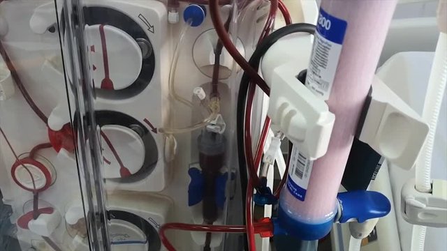 Close-up of a hemodialysis machine as it purifies a patient's blood at the clinic