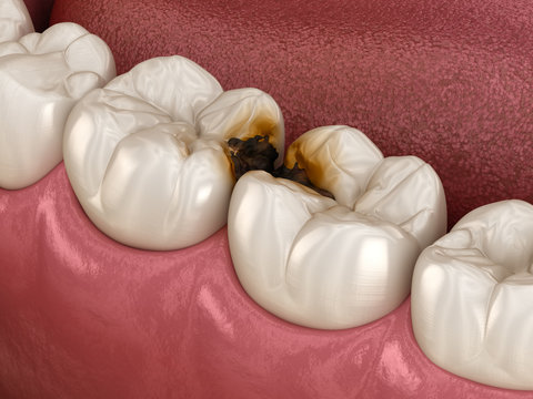 Molar teeth damaged by caries. Medically accurate tooth 3D illustration.