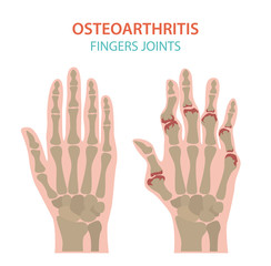 Arthritis, osteoarthritis medical infographic design. Joint replacement, implantant.