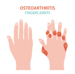 Arthritis, osteoarthritis medical infographic design. Joint replacement, implantant.
