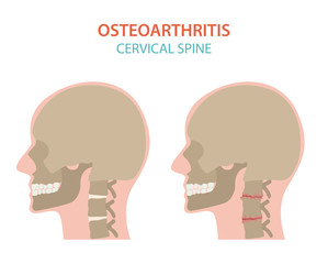 Arthritis, osteoarthritis medical infographic design. Joint replacement, implantant.