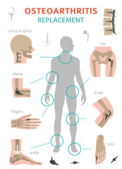 Arthritis, osteoarthritis medical infographic design. Joint replacement, implantant.