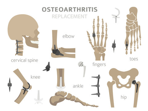 Arthritis, osteoarthritis medical infographic design. Joint replacement, implantant