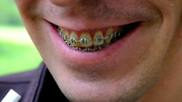 Brackets for yellowed teeth. Close-up of a smiling guy. The teeth of a smoking person. Dental concept. Shallow depth of field.